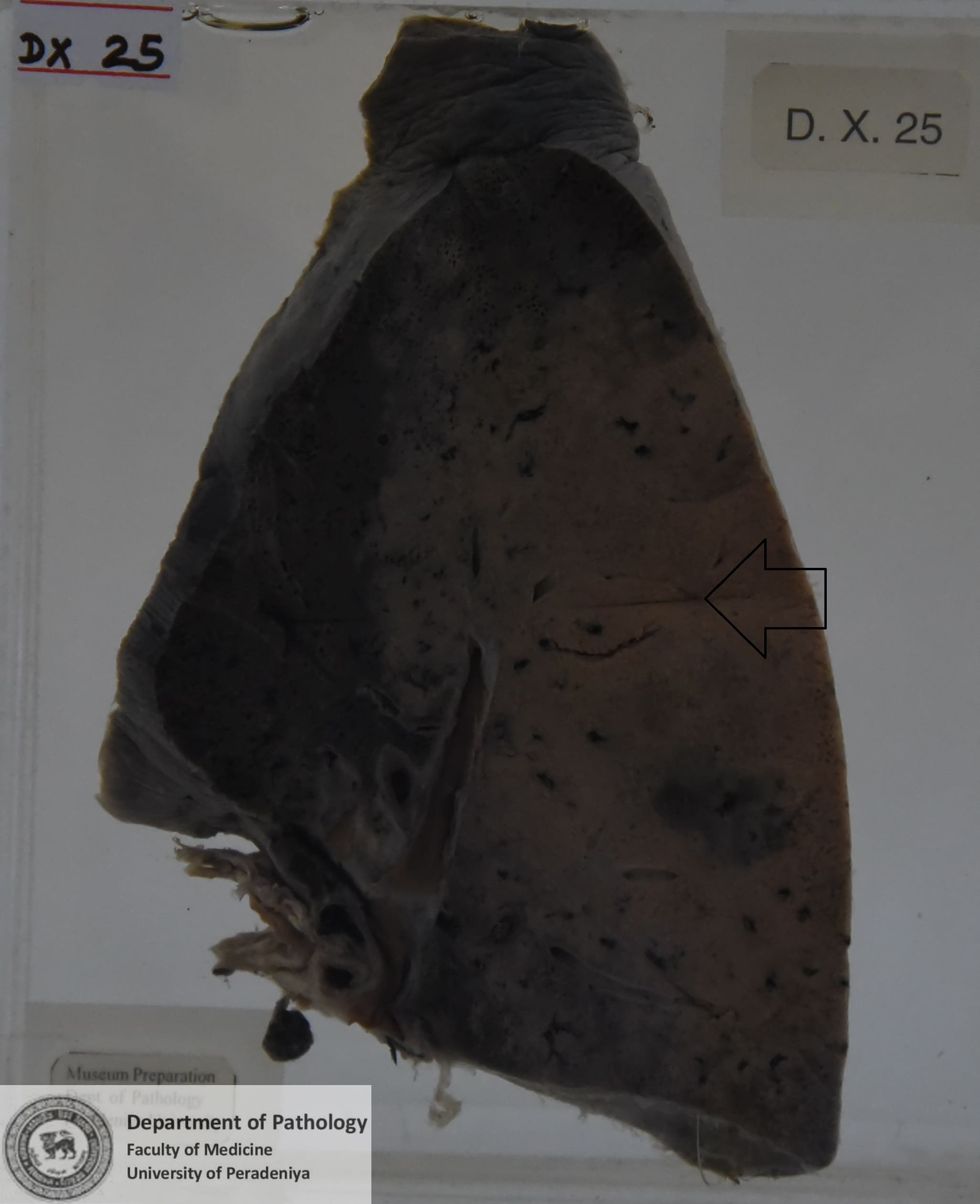 DX.25